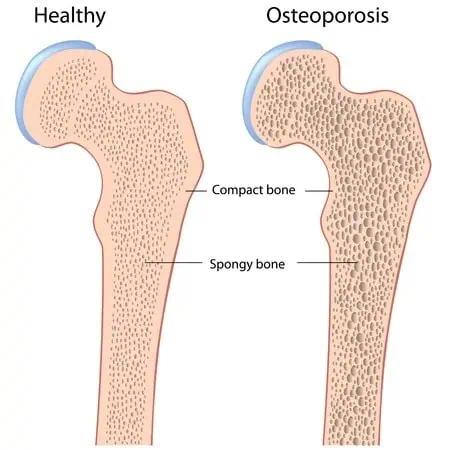 Comparison between healthy bone and bone afflicted with osteoporosis