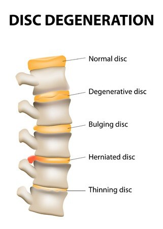 Degenerative Disc Disease and Long-Term Disability Claims