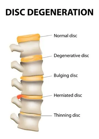 Disc degeneration chart showing a normal disc, degenerative disc, bulging disc, herniated disc, and a thinning disc