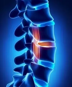 Image of a blue spine with a herniated disc