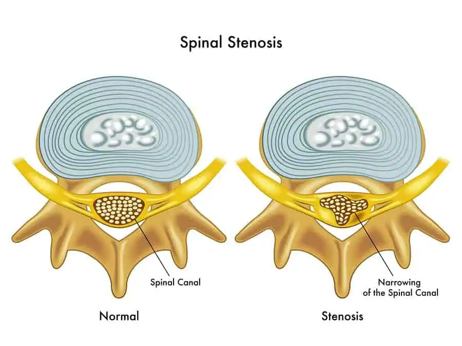A medical illustration of the effects of spinal stenosis